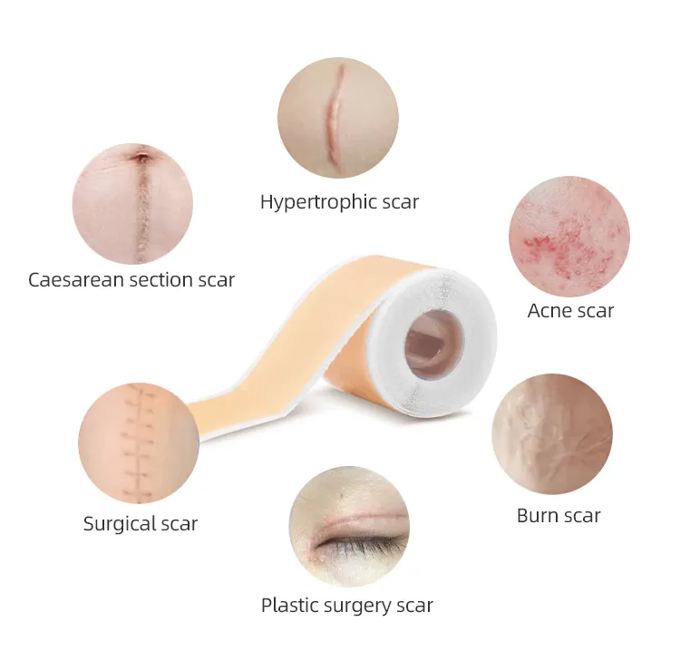 Hot Selling Scaraway Advanced Skincare Lange Silikon-Narben blätter für hypertrophe Narben und Keloide, die durch Operationen verursacht werden