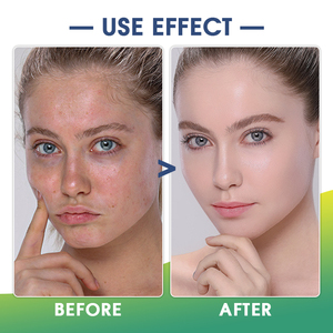 OEM <span class=keywords><strong>kozmetik</strong></span> günlük kullanım 100ml salyangoz bitkisel anti-akne yüz losyonu Niacinamide Paraben içermeyen nemlendirici onarım kollajen krem - Product Image 5