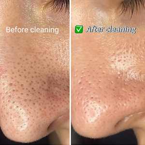 Puntas Hydra para Máquina Hydrafacial / Puntas para Máquina de Belleza <span class=keywords><strong>Facial</strong></span> de Hidrodermoabrasión Hydra-<span class=keywords><strong>Facial</strong></span> - Product Image 3