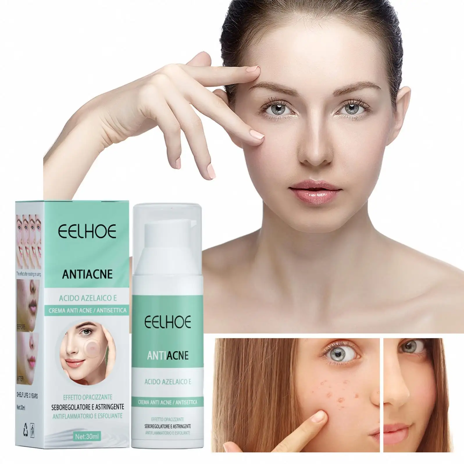 Neue heiße Pickel Salbe Anti-Akne-White ning Pflege produkte Gesichts-Kit Gesicht Anti-Akne-White ning-Creme 30ml