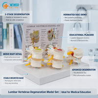 Modèle de comparaison de la dégénérescence des vertèbres lombaires en 4 étapes pour la formation médicale, modèle d'anatomie de la colonne vertébrale avec carte anatomique