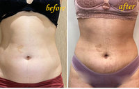 Peau recommandée par l'hôpital serrant la machine de chirurgie plastique laser liposuccion optique Fiberc Endolaser lifting du visage et du cou