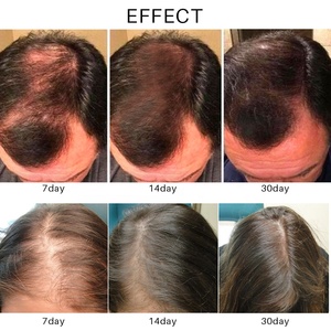 Laca para el cabello para el tratamiento de la pérdida de cabello aceite esencial para el crecimiento rápido del cabello - Product Image 5