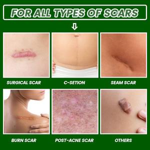 Crema OEM Eficaz <span class=keywords><strong>para</strong></span> Eliminar <span class=keywords><strong>Cicatrices</strong></span>, Gel <span class=keywords><strong>para</strong></span> el Acné, Reparación <span class=keywords><strong>de</strong></span> <span class=keywords><strong>Cicatrices</strong></span> y <span class=keywords><strong>Quemaduras</strong></span>, <span class=keywords><strong>Cicatrices</strong></span> del Embarazo, <span class=keywords><strong>Quemaduras</strong></span> por Calor, Crema <span class=keywords><strong>para</strong></span> Tratamiento <span class=keywords><strong>de</strong></span> Cirugía - Product Image 5