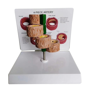 Medical Science Anatomy Artery Blood Vessel Medicine Pathology Thrombus teaching Model - Product Image 3
