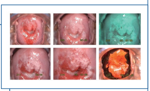 Super HD Colposcópio Preço Vídeo Colposcópio KN-2200I(H) Colposcópio Digital para Ginecologia 3.27MP Pixels Software Multifuncional - Product Image 5