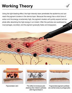 Láser de Picosegundos 1064nm 532nm para Eliminación de Marcas de <span class=keywords><strong>Nacimiento</strong></span> y Tatuajes, Láser Nd Yag Pico para Melasma, Peeling Facial con Carbón, Máquina Láser - Product Image 6
