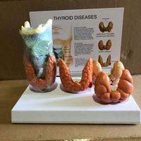 KyrenMed Thyroïde Modèle pathologique Thyroïde Larynx Maladies Modèle éducatif Nodule Goitre Thyroïdite Mastoïde Cancer