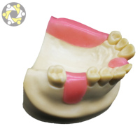Modèle d'implant dentaire personnalisable pour la science médicale, avec dent manquante en résine, 11x10x6 cm, pour l'enseignement et la pratique