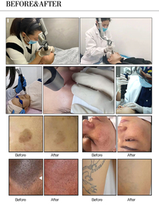 VLASTAR YNS602 Laser Picoseconde Nd Yag Q-Switched 532nm 2000W Refroidissement par Air pour l'Élimination des Tatouages et des Sourcils – Appareil de Beauté - Product Image 6
