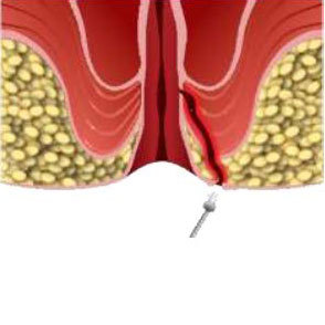 Máquina de Tratamiento de Hemorroides con Láser de Diodo de 980nm para Fístula <span class=keywords><strong>Anal</strong></span> y Hemorroides - Product Image 6