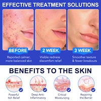 Crema ATOANY Quick Comfort & Renewal para el Cuidado de la Foliculitis y el Acné con 1% de Ácido Salicílico + Extractos Herbales para Cuero Cabelludo, Rostro, Cuerpo y Piel