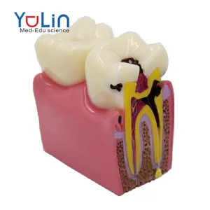 치아 충치 간호 모델 충치의 횡단면을 가진 치아 병변의 확대 된 해부학 모델