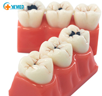 Modelo anatómico de enfermedad de caries dental con resina de aumento 3x modelo de cabeza de ciencia médica de PVC para escuelas entrenamiento de hospitales