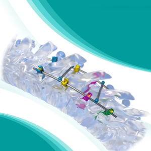 <span class=keywords><strong>Implant</strong></span> médical en titane de haute qualité, système 5.0mmCSS pour la chirurgie de la colonne vertébrale, certifié CE, vente directe d'usine - Product Image 6