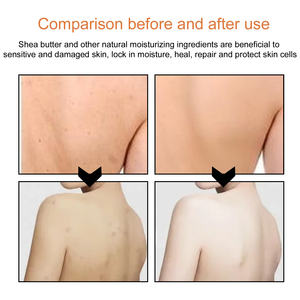 Savon anti-acné pour éliminer les taches brunes Savon réparateur pour le visage Savon nourrissant apaisant - Product Image 5