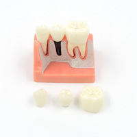 Modèle d'implant dentaire Éducation du patient Modèle dentaire Anatomie des dents Implant Couronne Pont Modèle de formation dentaire