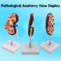 Reno normal y enfermo con perspectiva dual para patología, anatomía humana y educación CE/ISO