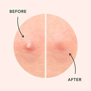 OEM Hydrocolloïde Invisible Pimple Master Patch Crème et <span class=keywords><strong>lotion</strong></span> pour le <span class=keywords><strong>visage</strong></span> cicatrisant l'acné avec Master Patch Spot Cover - Product Image 2