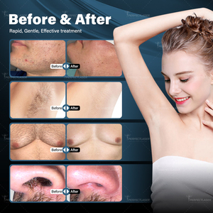 Preis für Schmerzfreies Permanentes Diodenlaser-Haarentfernungsgerät mit 4 Wellenlängen 755 808 940 1064nm mit KI-Hautanalysator und Eis-Diodenlaser - Product Image 6