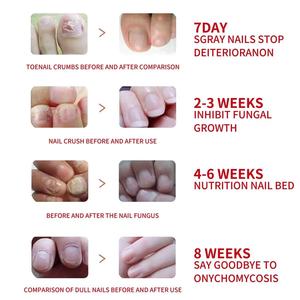 Solución Reparadora de <span class=keywords><strong>Uñas</strong></span> South Moon Herbal 20ml, Limpia, Blanquea y Nutre <span class=keywords><strong>las</strong></span> <span class=keywords><strong>Uñas</strong></span>, Cuidado Antifúngico <span class=keywords><strong>para</strong></span> <span class=keywords><strong>Uñas</strong></span> de los Pies, Paquete Individual - Product Image 3