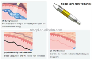 Arañas vasculares Diodo vascular 980nm Vasos sanguíneos rojos EVLT Venas varicosas Tratamiento de venas faciales para piernas Láser de diodo 980nm - Product Image 6