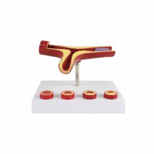 Herramienta de Enseñanza de Educación Médica, Modelo Educativo de <span class=keywords><strong>Arteriosclerosis</strong></span> de 10 Veces el Tamaño Real, Modelo de Arteria - Product Image 2