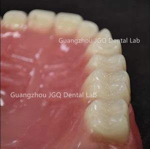 ฟันปลอมอะคริลิกคุณภาพสูงแบบสั่งทำพิเศษ ช่วยฟื้นฟูการทำงานและรูปลักษณ์ของฟันให้กลับมาเป็นธรรมชาติ - Product Image 5