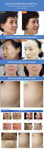 Newest Design 2026 2-in-1 RF-Microneedle Device Insulating Pins Scar Removal Acne Skin Firming Tightening Facial Portable - Product Image 6