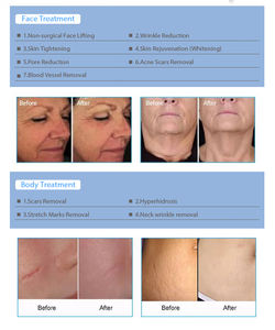 Équipement RF portable, <span class=keywords><strong>radiofréquence</strong></span>, lifting cutané, traitement des cicatrices d'acné, <span class=keywords><strong>micro</strong></span>-aiguilletage fractionné RF, meilleur équipement de beauté du visage - Product Image 2