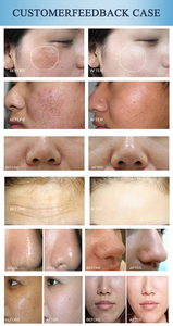 Appareil professionnel 10-en-1 à jet d'oxygène pour raffermir la peau, estomper les ridules et resurfaçage cutané hydratant - Product Image 6