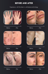 Xách tay mát Plasma da thắt chặt da trẻ hóa điều trị mụn trứng cá máy công nghệ cho giảm nếp nhăn phát sáng da - Product Image 6