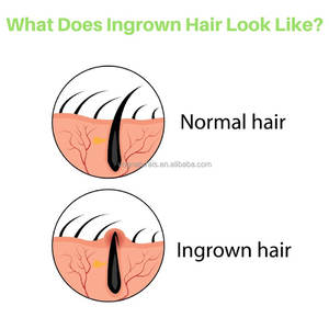 Crema para el Tratamiento del Vello Encarnado de Marca Privada, Eliminador de Irritación y Quemaduras por Afeitado, <span class=keywords><strong>Gel</strong></span> Calmante para Después del Afeitado - Product Image 3