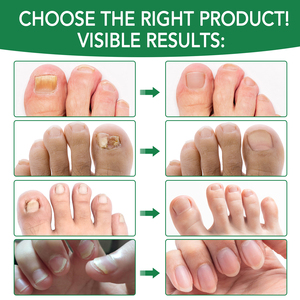 YECUCE Solution <span class=keywords><strong>Huile</strong></span> Anti-<span class=keywords><strong>Mycose</strong></span> des Ongles en Promotion – Sérum Liquide Traitement Pied d'Athlète et <span class=keywords><strong>Mycose</strong></span> des Ongles pour la Réparation et la Croissance des Ongles - Product Image 4