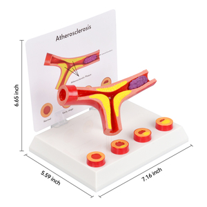 Modelo Anatómico de <span class=keywords><strong>Arteriosclerosis</strong></span> de 4 Partes con Sección Transversal de Arteria, Modelo de Ciencia Médica para Enseñanza Médica a Pacientes y Doctores - Product Image 4