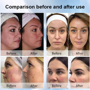 Máquina de Rejuvenecimiento Facial y Corporal, Eliminación de Acné, Cicatrices y Arrugas, Masajeador de Senos, Disponible en EE. UU. - Product Image 6