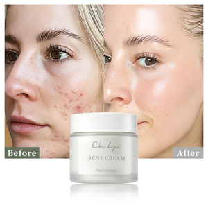 Crema Viso all'<span class=keywords><strong>Acido</strong></span> <span class=keywords><strong>Salicilico</strong></span> per Rimozione <span class=keywords><strong>Acne</strong></span> e Idratazione, Ideale per Studenti - Product Image 1