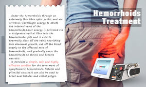 Láser de Diodo <span class=keywords><strong>Nd</strong></span>:YAG Portátil Starlight <span class=keywords><strong>ST</strong></span> 1470/980nm con Sistema de Enfriamiento por Aire para Cirugía de Liposucción y Tratamiento Estético de Hemorroides - Product Image 2