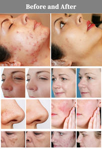 Láser de fibra de tulio de venta caliente del fabricante para urología, máquina de láser fraccional de CO2 para piel y mobiliario de salón de láser fraccional de CO2 - Product Image 6