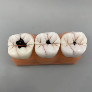 Modèle de classification de la carie dentaire quadruple Science médicale Maladie de la carie dentaire - Product Image 6