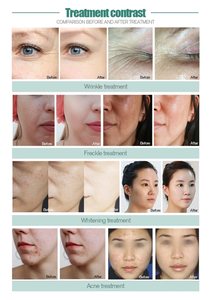 Máquina de Tratamientos Faciales de Alta Presión con Hidro-Oxígeno para Cabello y Cuero Cabelludo, Pistola de Mesoterapia con Inyección de Agua para Hidratación - Product Image 5