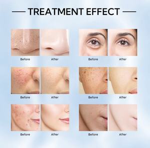 Appareil professionnel de rajeunissement du visage par ultrasons 12 en 1, haute fréquence pour le nettoyage en profondeur du visage, des points noirs et de l'oxygène - Product Image 6