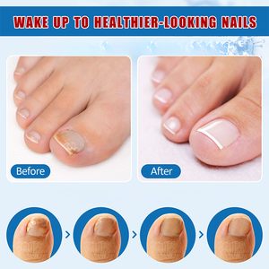 Gran oferta de líquido para tratamiento de hongos en las uñas, solución eficaz para la infección fúngica de las uñas de los pies, fórmula de hierbas naturales - Product Image 5