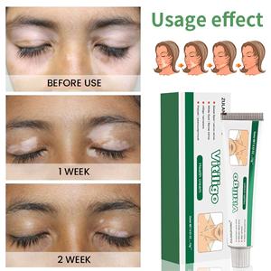 Cross-Border para <span class=keywords><strong>Amazon</strong></span> y AliExpress 20g White Spot Melasma Ungüento Cuerpo Líquido antibacteriano para el cuidado de la piel de Limpieza de manchas - Product Image 3
