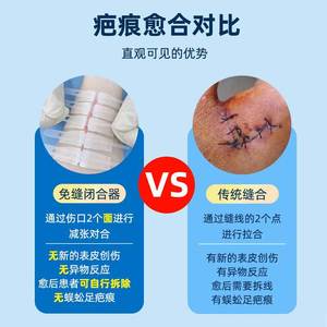 Medical Wound Tension Reducer Steri Strips 5-Piece White PP Material For Scar Healing And Sutureless Closure - Product Image 4