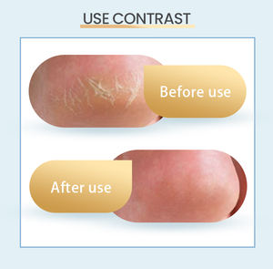 Fabrika Kalitesinde Çay Ağacı Ayak Maskesi, Ayak Bakımı için Hyaluronik Asit İçeren Nemlendirici Formül - Product Image 5