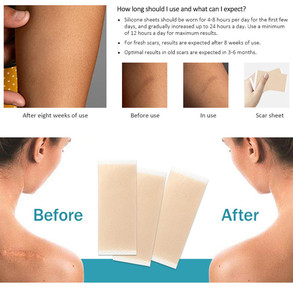 Patch en gel de silicone couleur chair, pansement médical pour traitement des cicatrices, emballage individuel jetable, patch en silicone pour cicatrices, pâte cicatrisante - Product Image 6