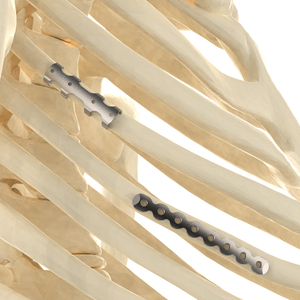 CANWELL Plaque de verrouillage des côtes en titane Fixation osseuse Implant orthopédique pour chirurgie des fractures CE ISO - Product Image 4