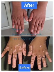 Lámpara Portátil de Fototerapia UVB Clínica para Trastornos de la Piel, Vitíligo, Psoriasis y <span class=keywords><strong>Dermatitis</strong></span> Atópica, Modelo KN-4003BL 311nm - Product Image 4