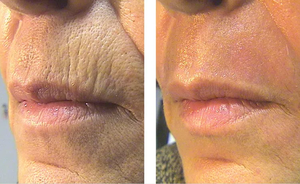 Appareil de thérapie faciale au laser fractionné au CO2 en dermatologie pour remodeler la peau, laser fractionné pour éliminer les rides, élimination des vergetures - Product Image 6